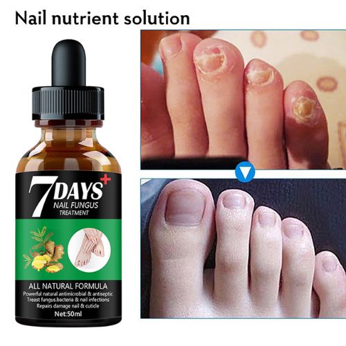 Foot Nail Fungus Treatment Serum with herbal ingredients for nail repair and hydration